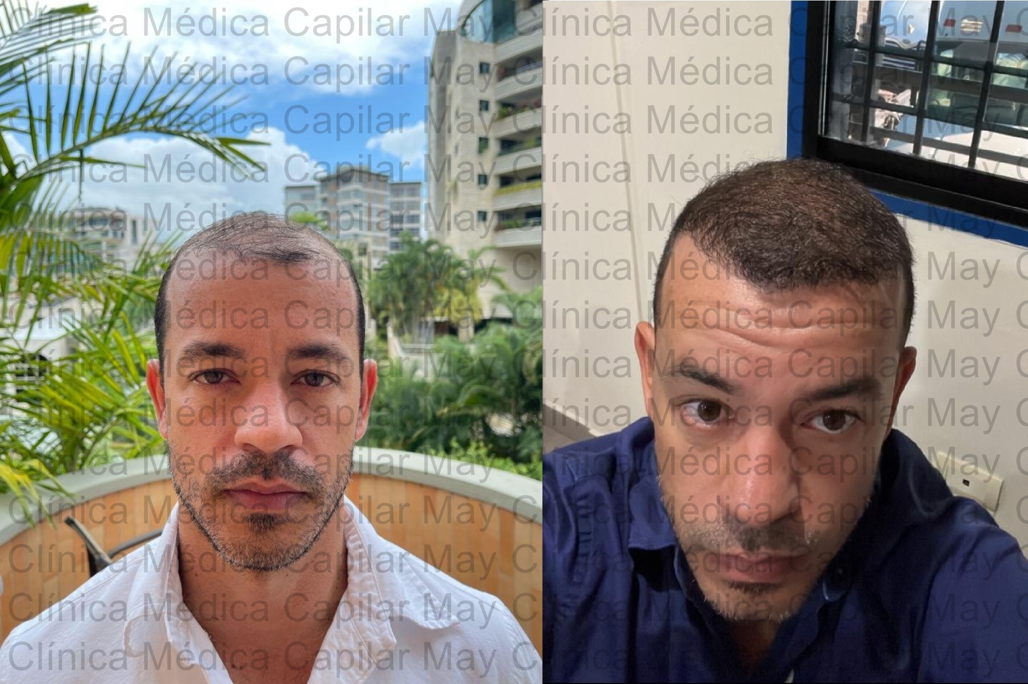 antes y después trasplante capilar