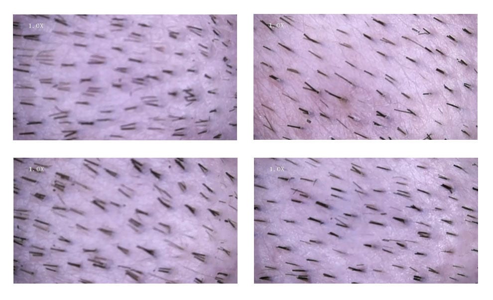 Técnica SCT - Stem Cell Transfer
