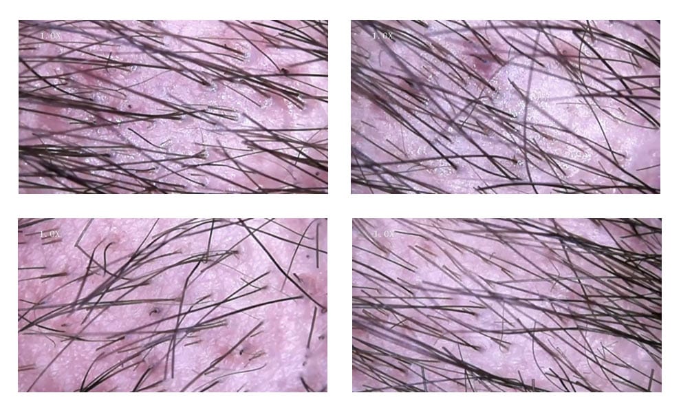 Técnica SCT - Stem Cell Transfer