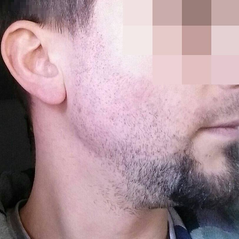 Implante de barba. 12 días después