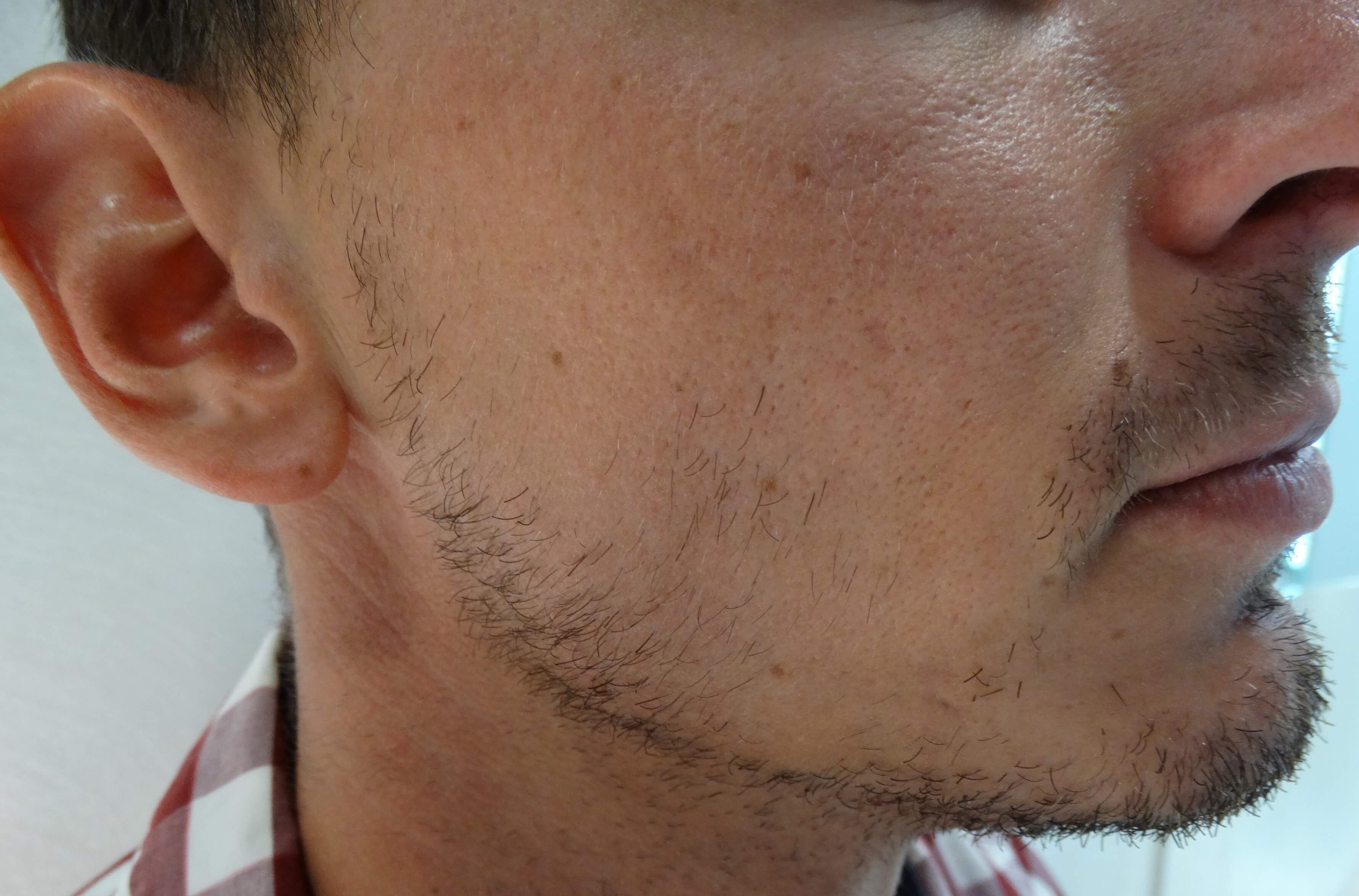 Implante de barba. Antes