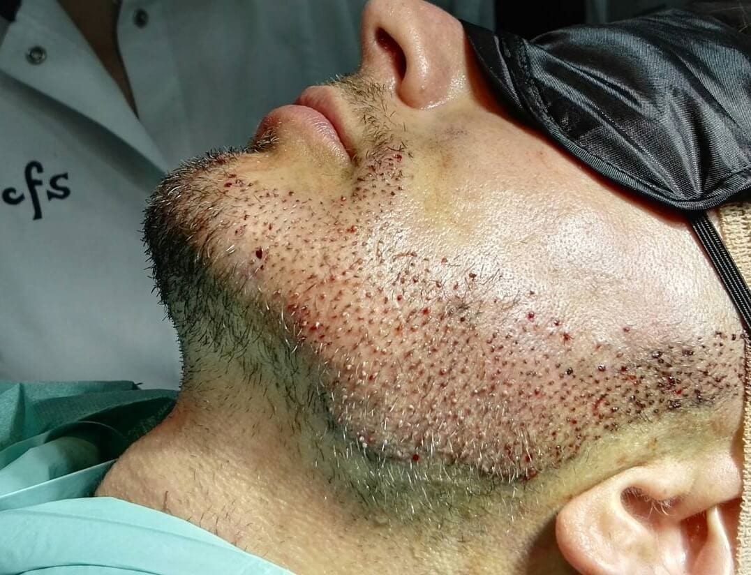 técnica de injertos capilares de barba