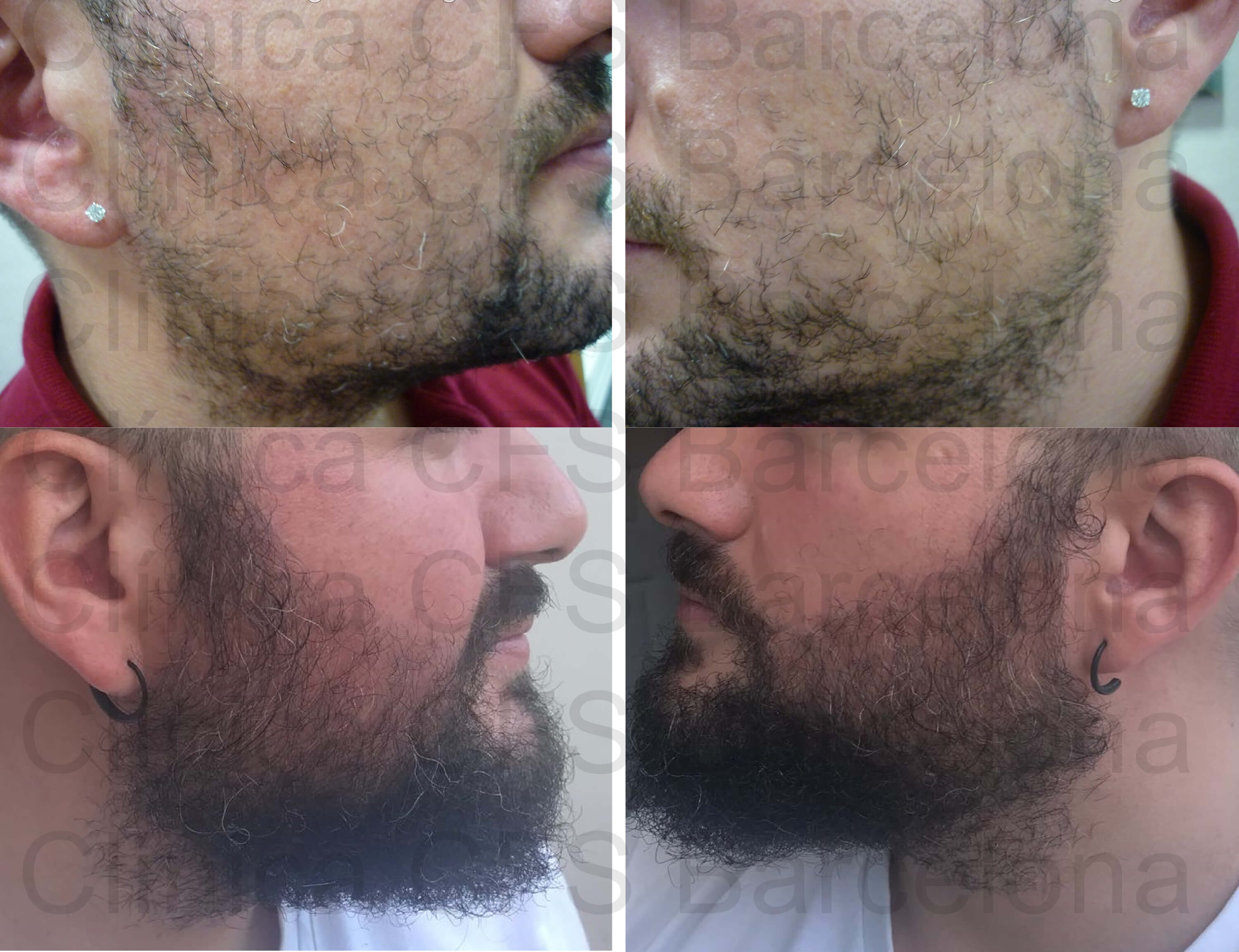 Injerto de barba. Barba antes-después