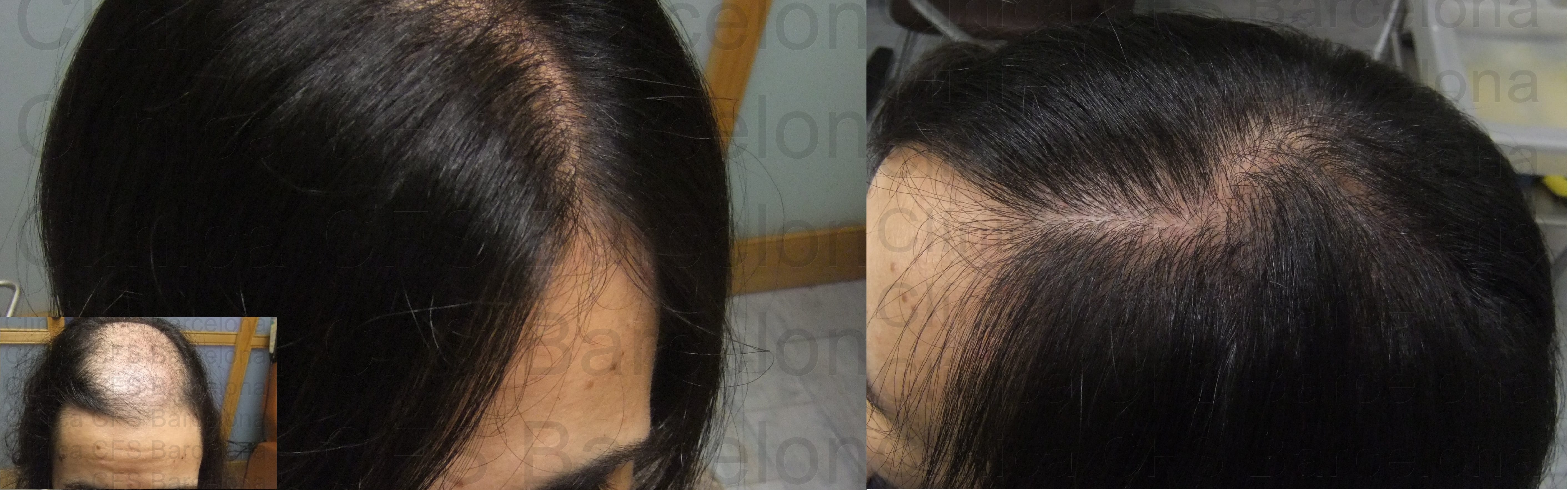 Implantes capilares en mujeres | Grupo Capilar CFS