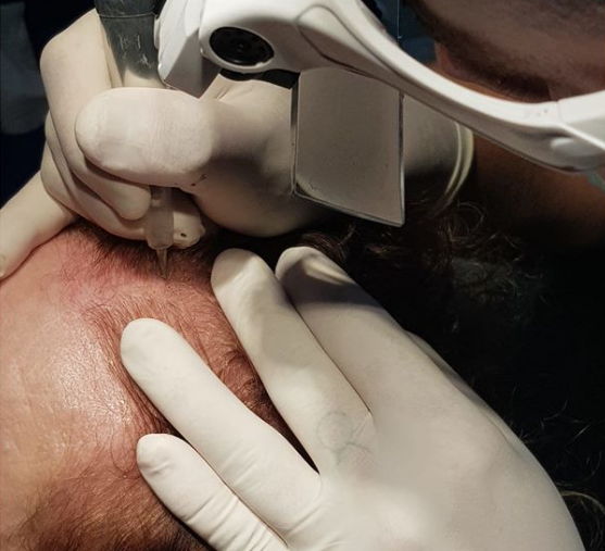 hair graft techniques hair micro-pigmentation