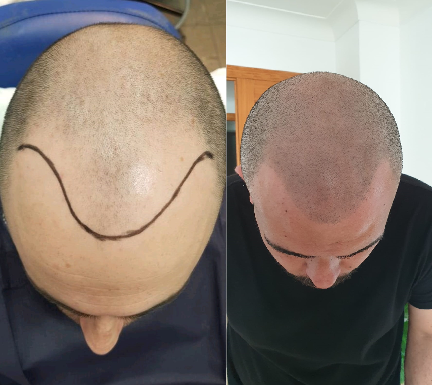 Micropigmentación Capilar efecto rapado Micropigmentacion Capilar