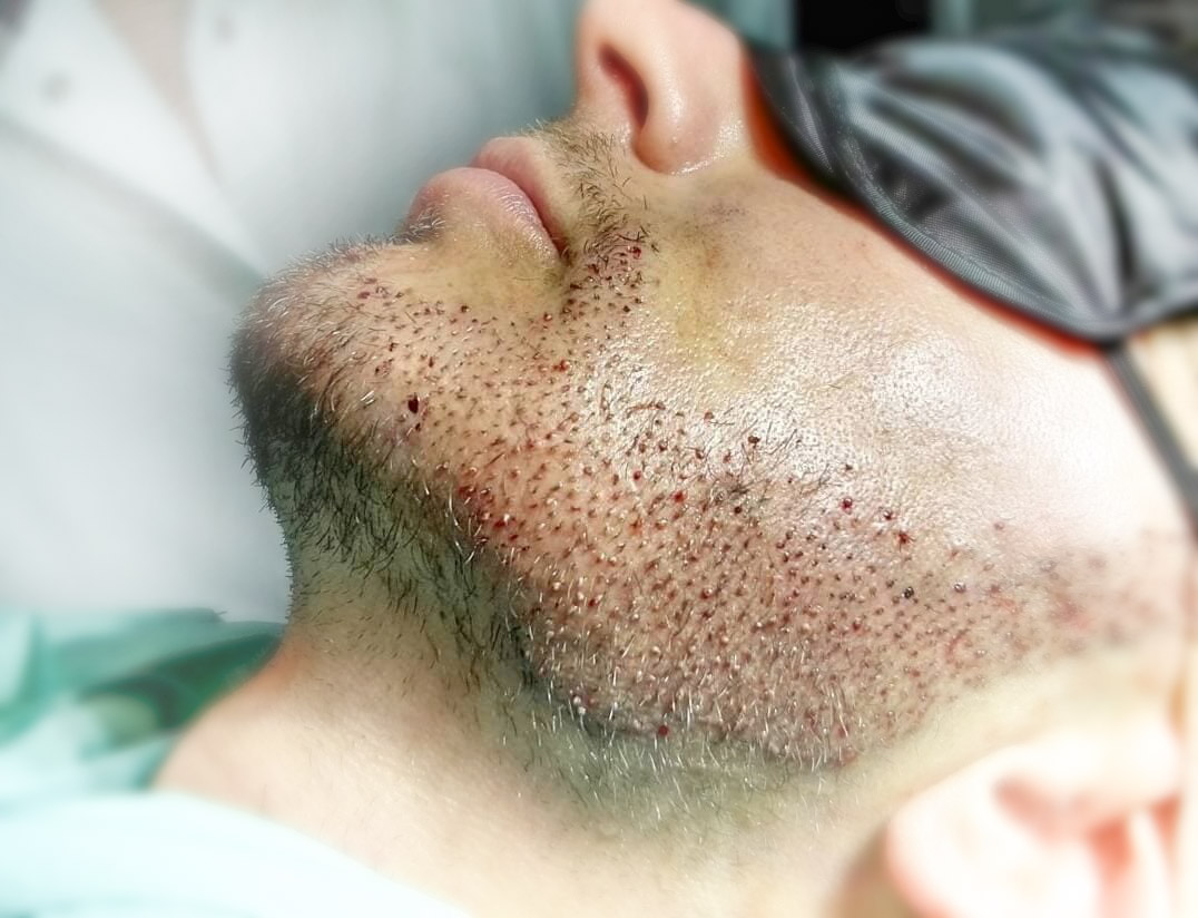 Foto de un implante de barba