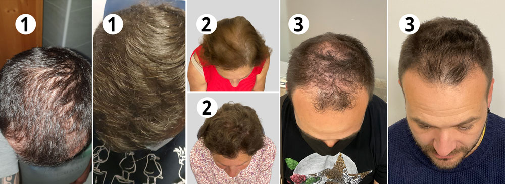 Fotos de un pacientes del antes y el después con nuestro tratamiento personalizado para fortalecer el cabello.