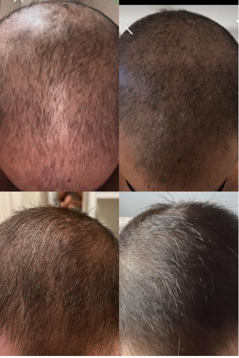 Evolución alopecia 6 meses