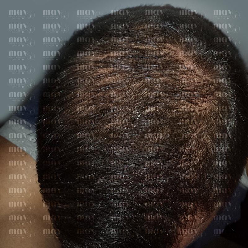 densidad injerto capilar mes 8 mejora del grosor y volumen