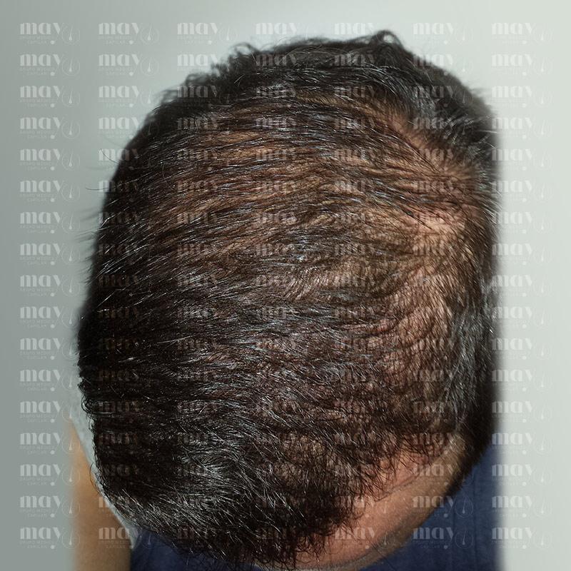 densidad injerto capilar mes 8 mejora del grosor y volumen