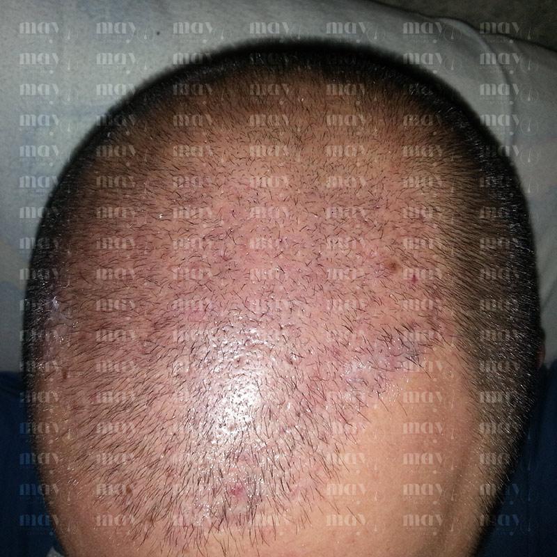 zona implantada sin crecimiento visible en el tercer mes