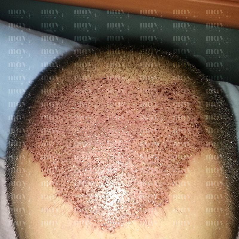 injerto capilar primeros días con costras zona implantada