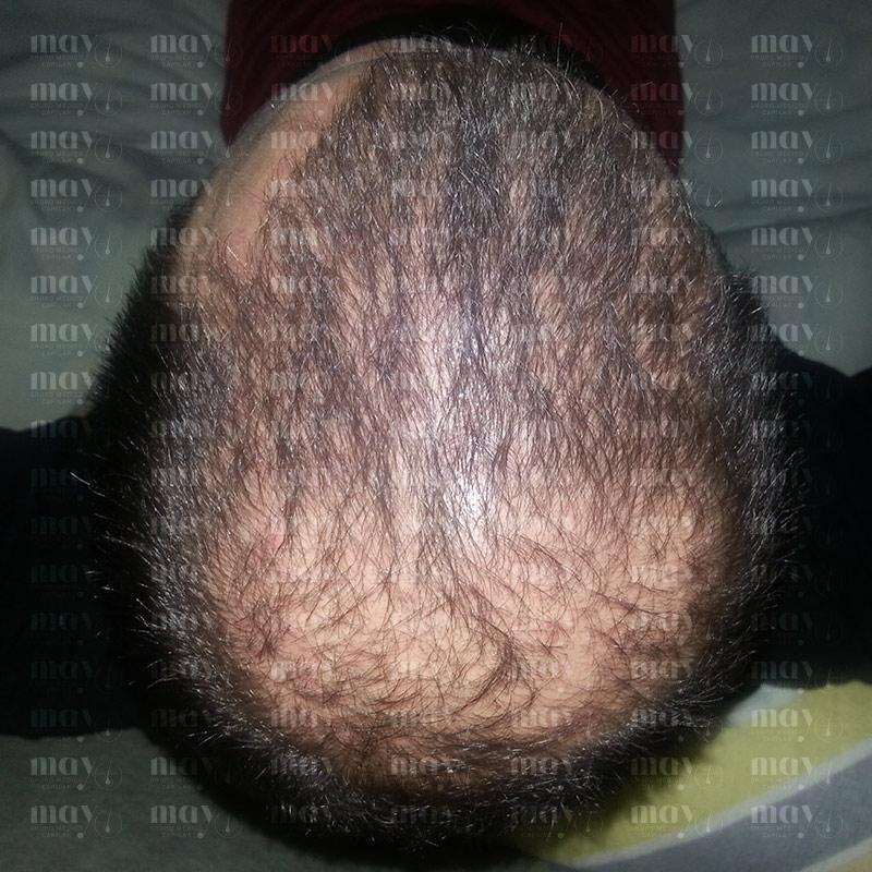 primeros resultados injerto capilar mes 5 crecimiento inicial del cabello
