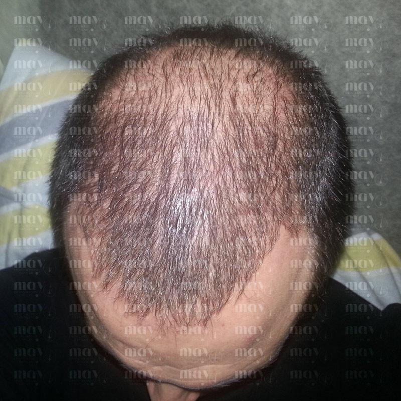 primeros resultados injerto capilar mes 5 crecimiento inicial del cabello