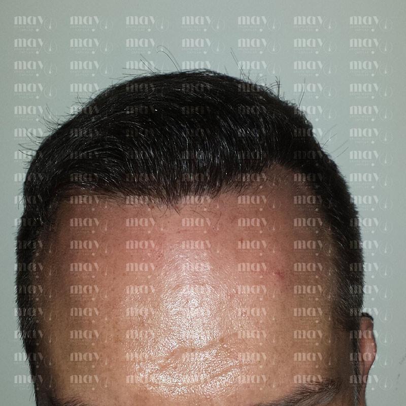 resultado final injerto capilar 12 meses antes y después