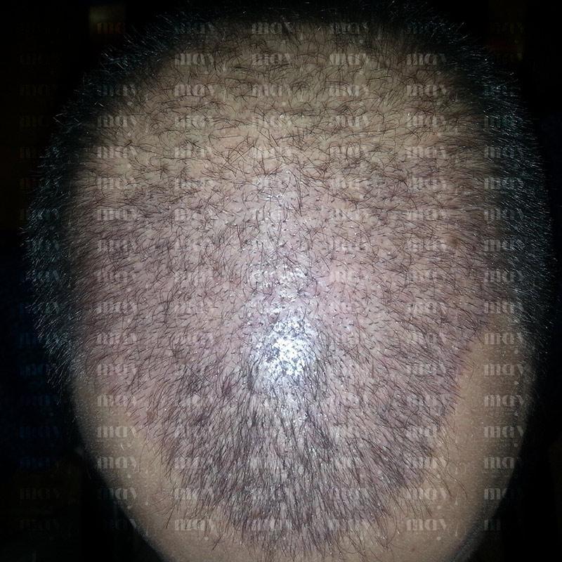 shock loss injerto capilar mes 1 caída del cabello tras trasplante