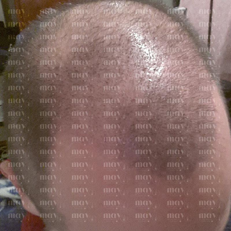 shock loss injerto capilar mes 1 caída del cabello tras trasplante