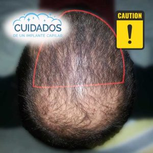 Cuidados-de-un-implante-capilar