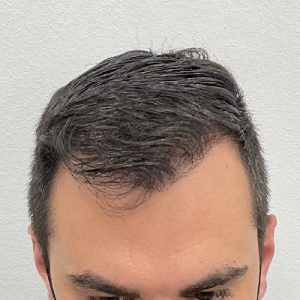 Descubre el resultado de un implante capilar