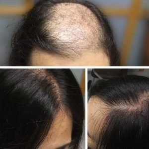 Implantes-capilares-en-mujeres