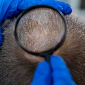 Parar-la-caída-de-pelo