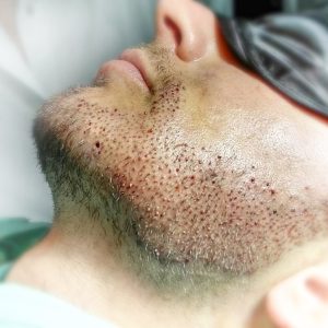 Foto de un implante de barba