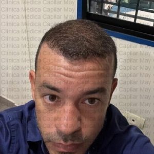 trasplante capilar